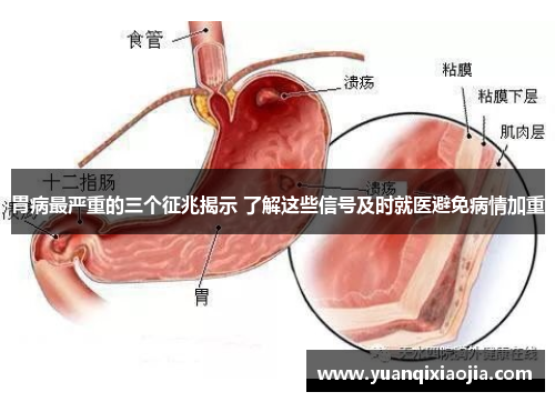 胃病最严重的三个征兆揭示 了解这些信号及时就医避免病情加重